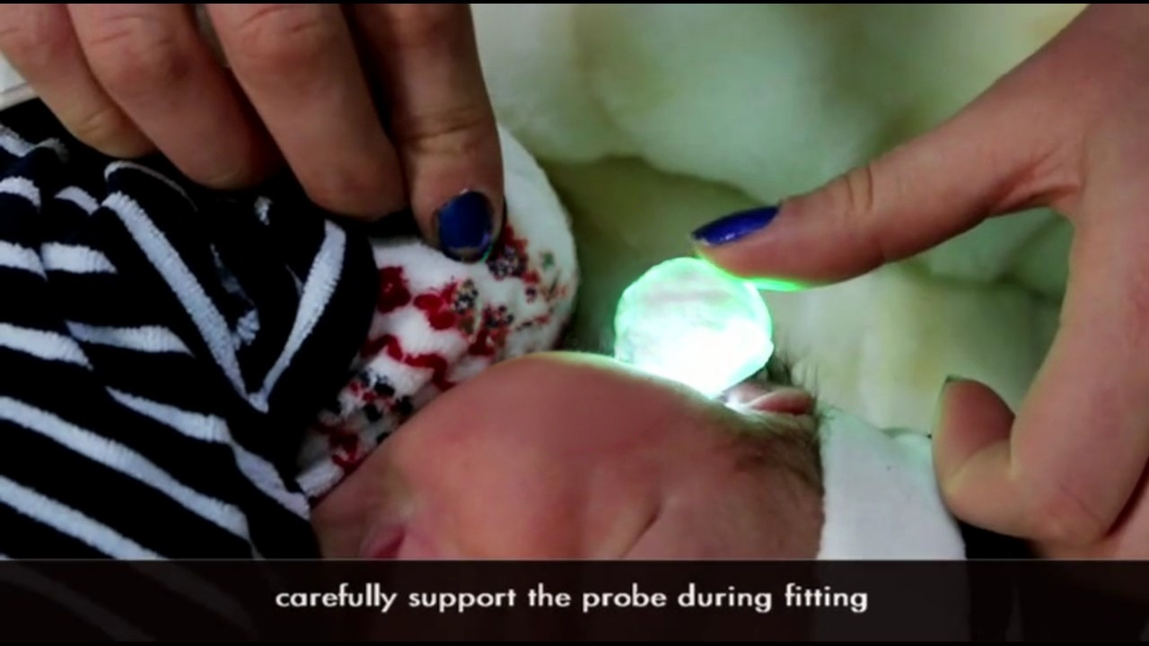TEOAE Screening on neonate with SENTIERO